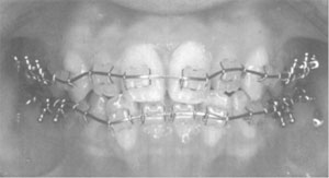 歯列矯正ワイヤ