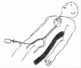 カテーテル治療の概念